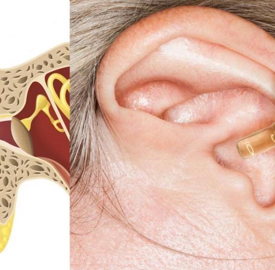 Այս բնական միջոցը կաթեցրեք ականջի մեջ և այն կվերացնի ականջների խցանումը ու մի քանի անգամ կալավացնի լսողությունը