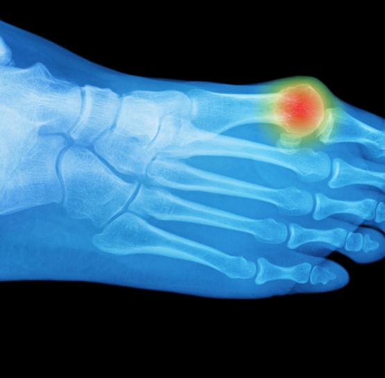 4 պատճառ, որը առաջացնում է ոտքերի ոսկորի գերաճ