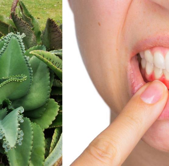 Այս բույսը կօգնի ձեզ վերացնել լնդերի արյունահոսությունը, բորբոքումն ու բերանի տհաճ հոտը