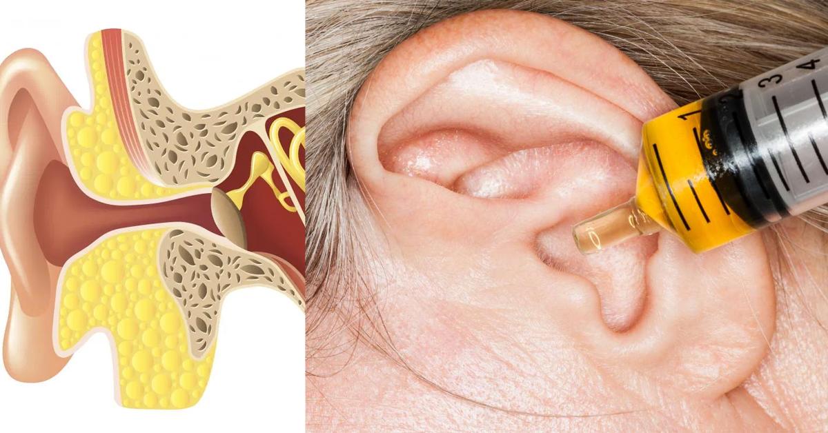Այս բնական միջոցը կաթեցրեք ականջի մեջ և այն կվերացնի ականջների խցանումը ու մի քանի անգամ կալավացնի լսողությունը