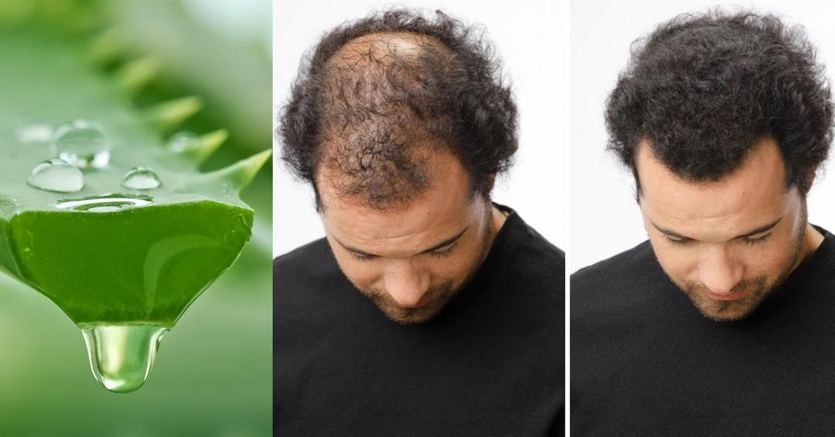 Այս բնական միջոցը բազմաթիվ մարդկանց է օգնել ազատվել մազաթափությունից նար մազեր պարգևել նրանց