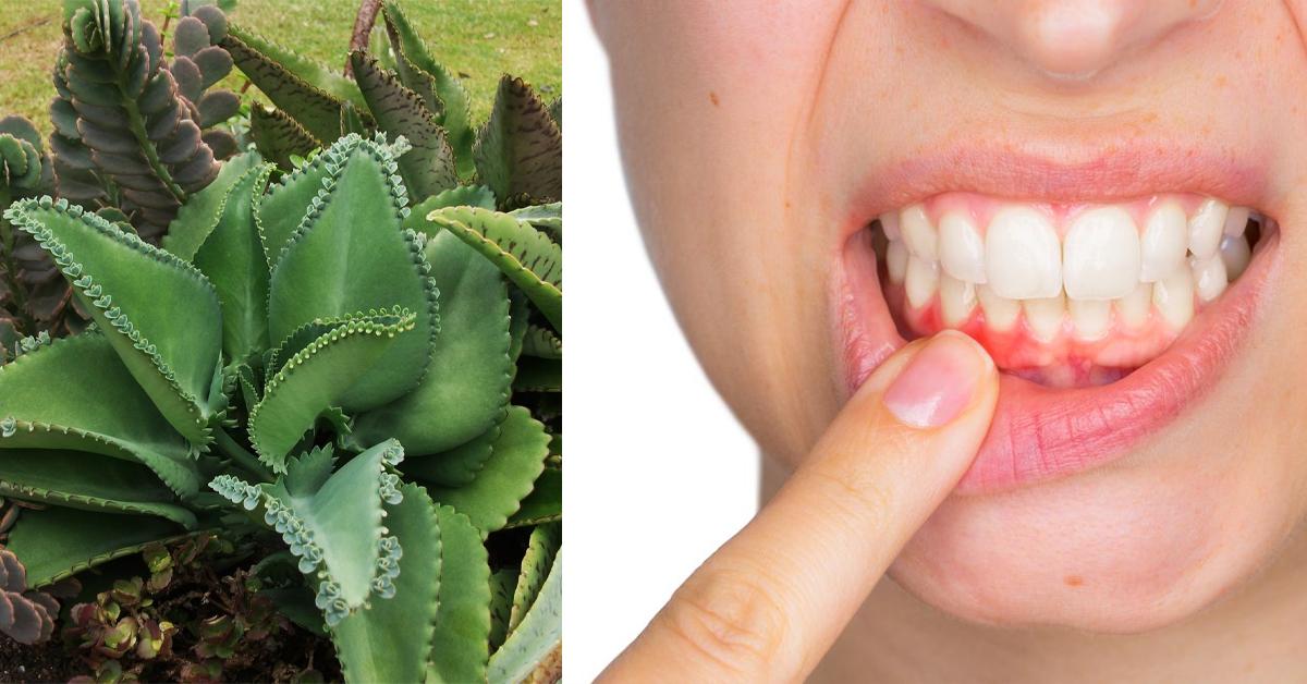 Այս բույսը կօգնի ձեզ վերացնել լնդերի արյունահոսությունը, բորբոքումն ու բերանի տհաճ հոտը