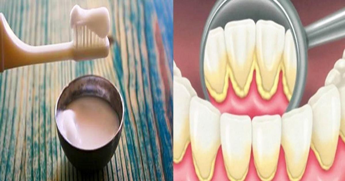Ատամնաքարերը մաքրելու համար կարող եք օգտագործել այս բնական միջոցը