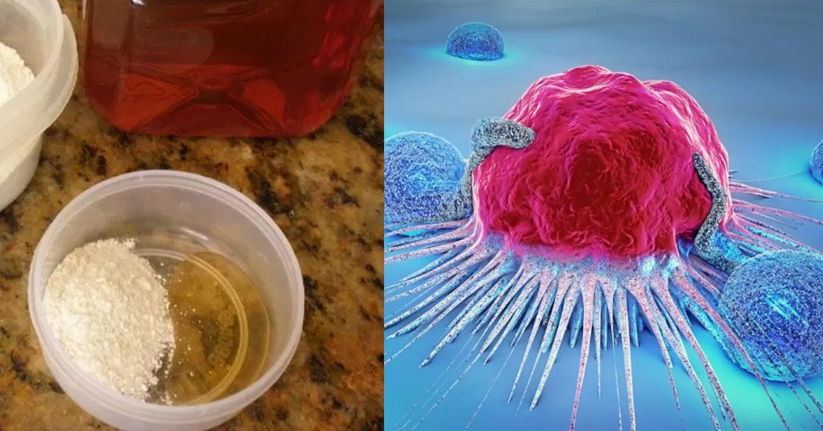 Ինչպե՞ս մեղրի և սոդայի օգանությամբ բուժել քաղցկեղը